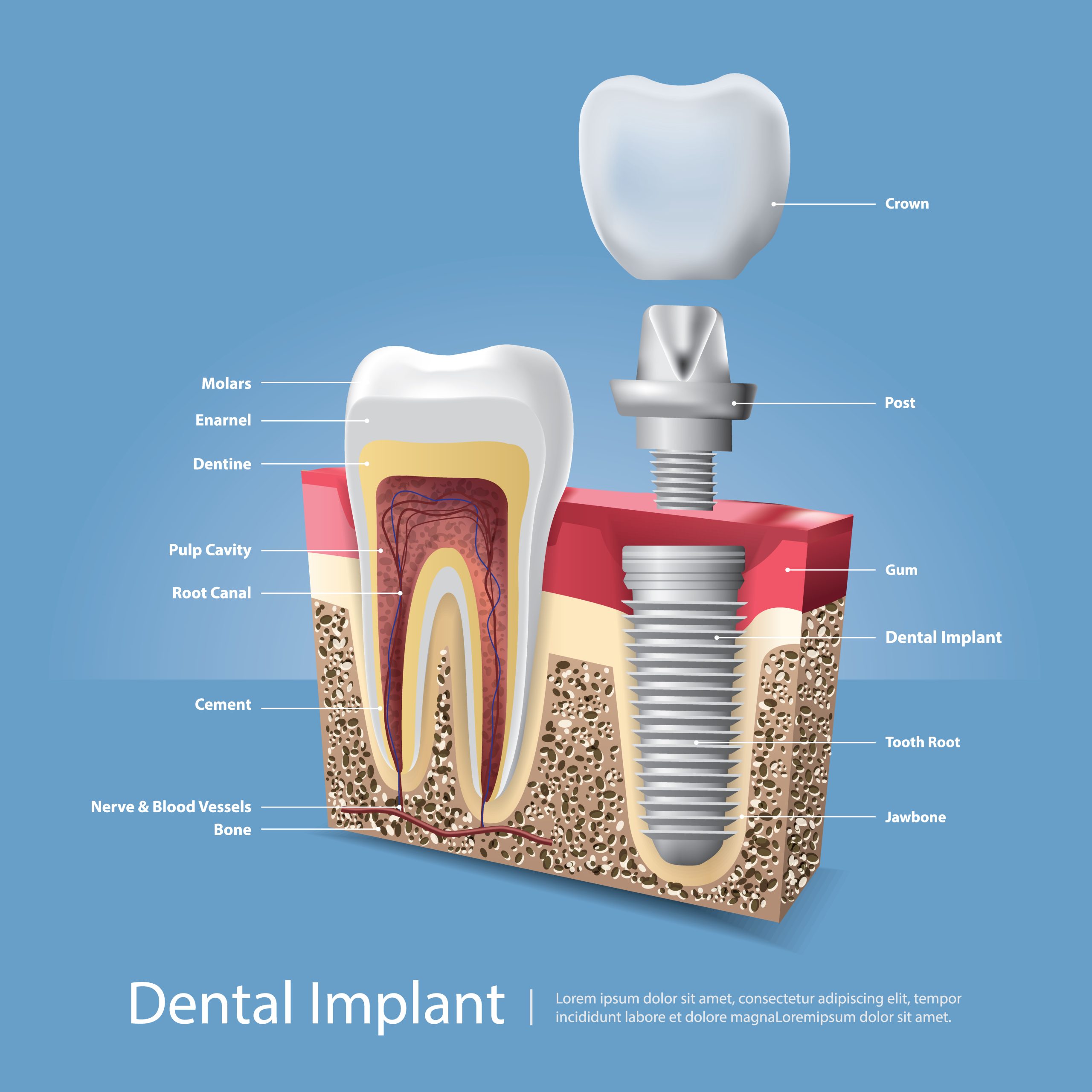 Looking for dental implants in Boudha, Kathmandu? Annapurna Dental Clinic offers safe, long-lasting implants for missing teeth.