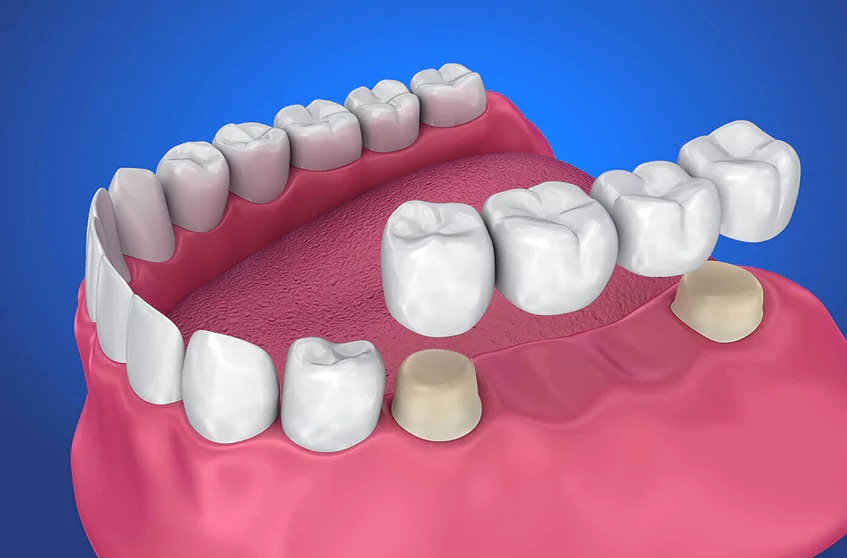 Crowns and Bridges Service Boudha Kathmandu Annapurna Dental Care